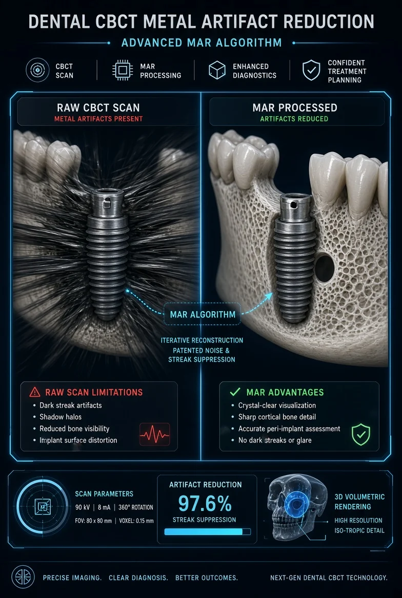Comparatif des algorithmes de réduction des artéfacts métalliques : Les clés pour visualiser l'os péri-implantaire sans halos ni ombres portées