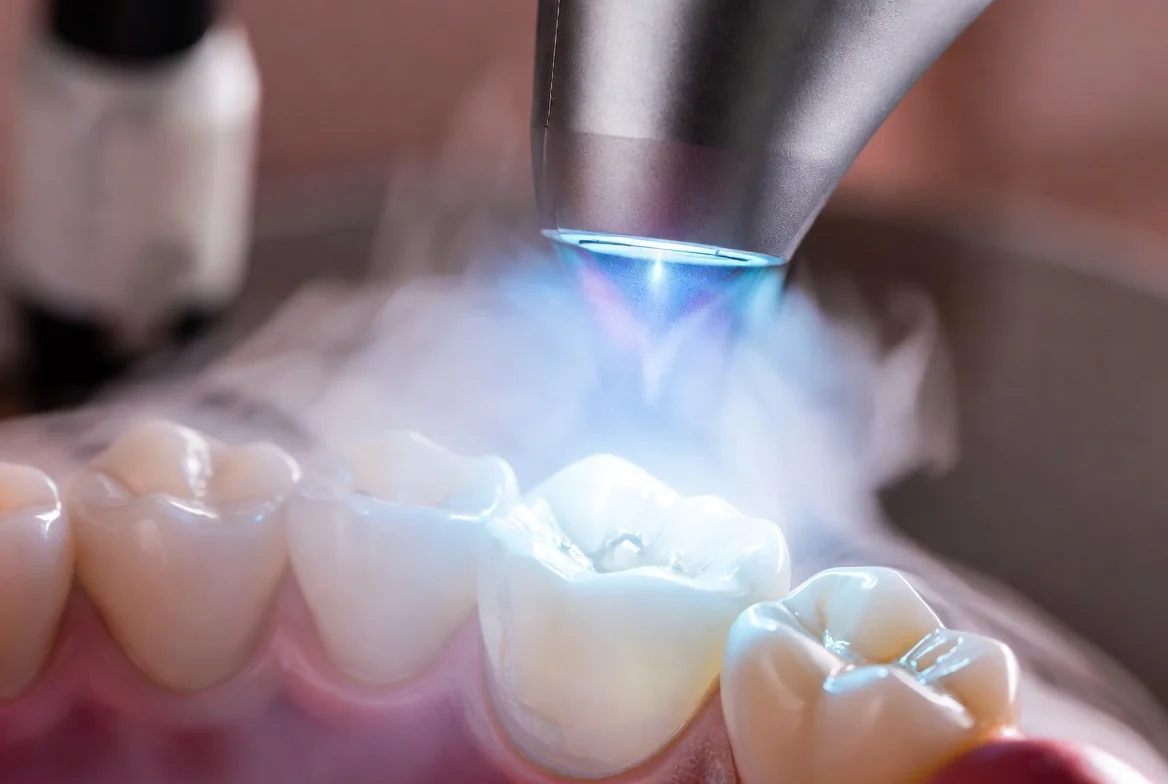 La gestion thermique en photopolymérisation : Protocoles cliniques pour protéger la pulpe et les tissus mous